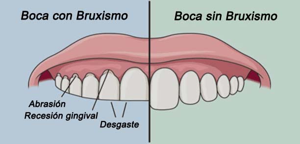 bruxismo02